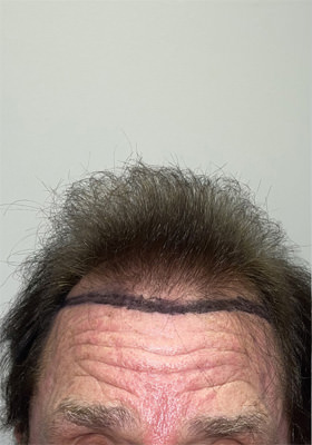 hair transplant before after Photos