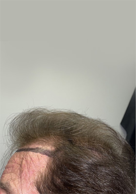 hair transplant before after Photos