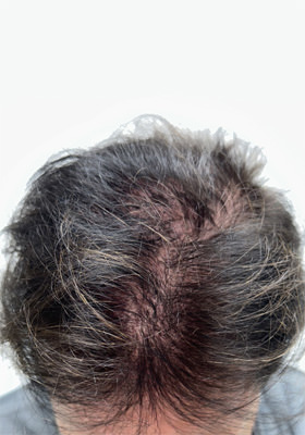 hair transplant before after Photos