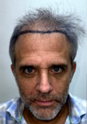 hair transplant photos