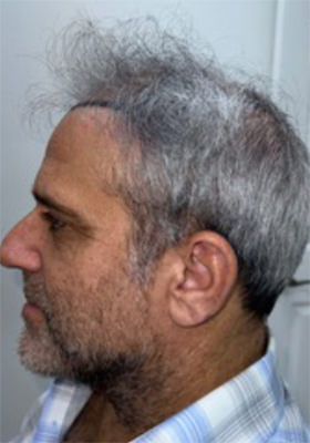 hair transplant before after Photos