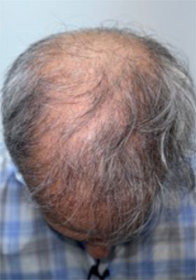 hair transplant before after Photos