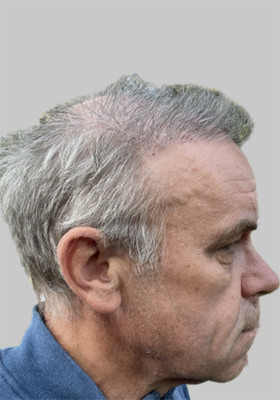 hair transplant photos