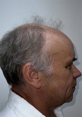 hair transplant before after Photos