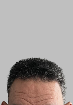 hair transplant before after Photos