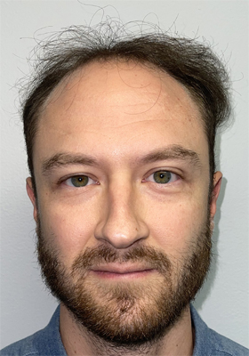 hair transplant photos