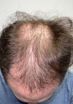 hair transplant before after Photos