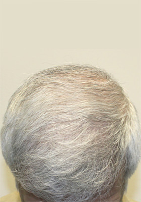 hair transplant photos