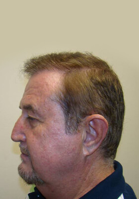 hair transplant photos