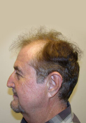 hair transplant photos