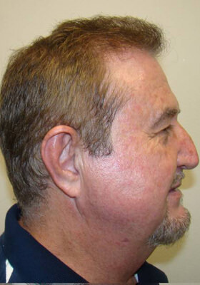 hair transplant photos