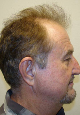 hair transplant before after Photos