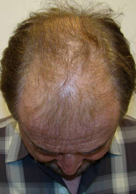 hair transplant photos