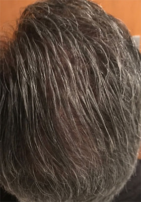 hair transplant before after Photos