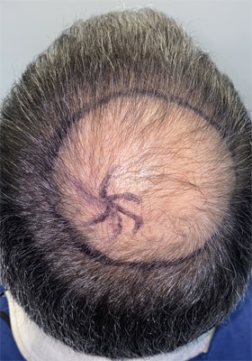 hair transplant before after Photos