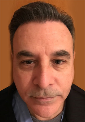 hair transplant photos