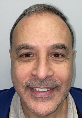 hair transplant photos