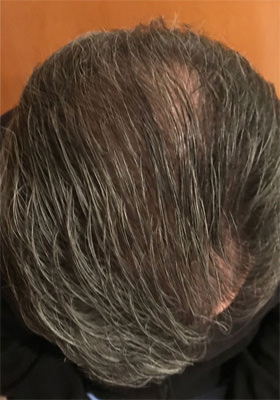 hair transplant photos