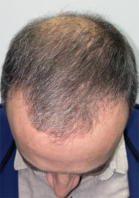 hair transplant before after Photos