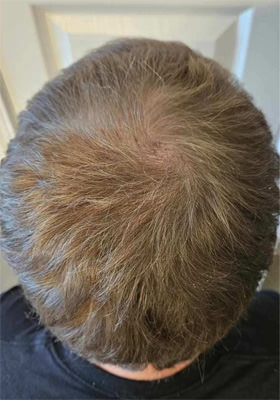 hair transplant before after Photos