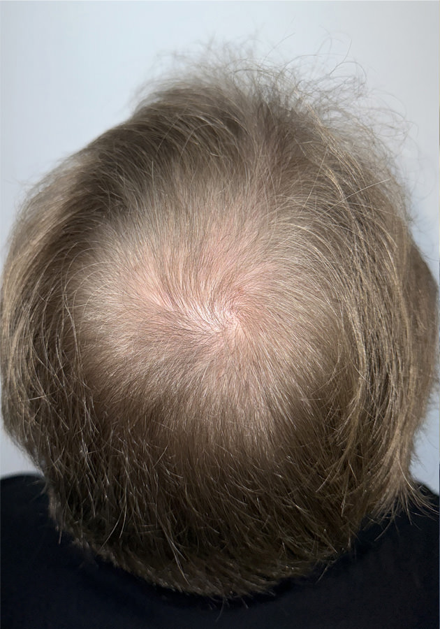 hair transplant before after Photos