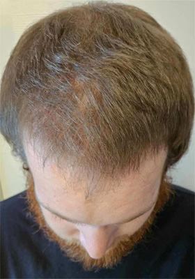 hair transplant before after Photos