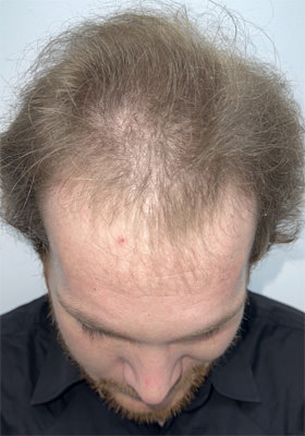 hair transplant photos