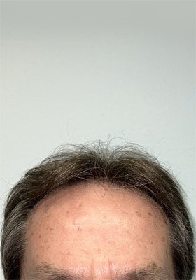 hair transplant before after Photos