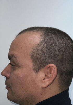 hair transplant before after Photos