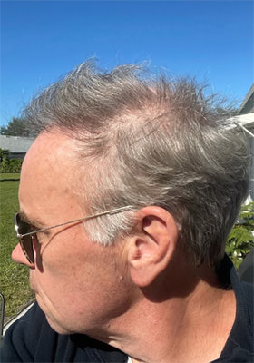 hair transplant before after Photos