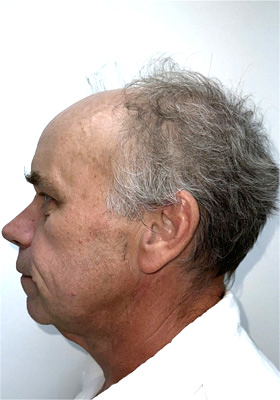 hair transplant before after Photos