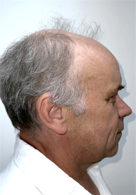 hair transplant before after Photos