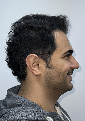 hair transplant before after Photos