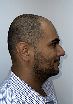 hair transplant before after Photos