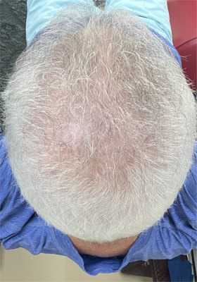 hair transplant before after Photos