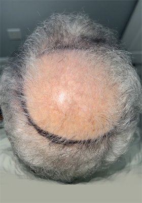 hair transplant photos