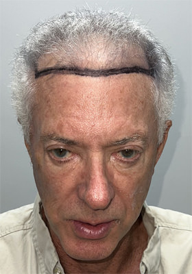 hair transplant photos