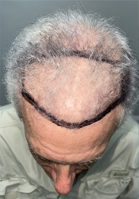 hair transplant before after Photos