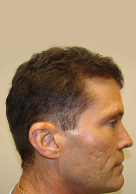 hair transplant photos