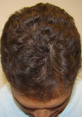 hair transplant photos