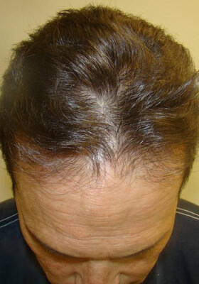 hair transplant photos