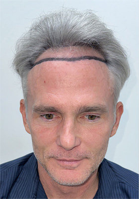 hair transplant photos