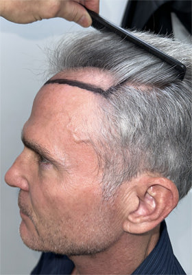 hair transplant photos