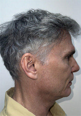 hair transplant photos