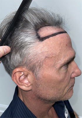 hair transplant before after Photos