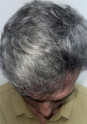 hair transplant before after Photos