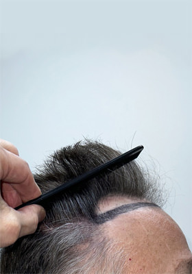 hair transplant before after Photos