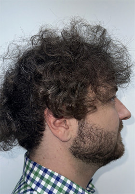 hair transplant before after Photos