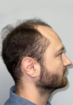 hair transplant before after Photos