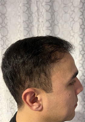 hair transplant before after Photos